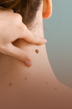 EXERESE DE LESÕES E PINTAS