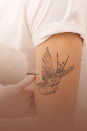 REMOÇÃO DE TATUAGEM